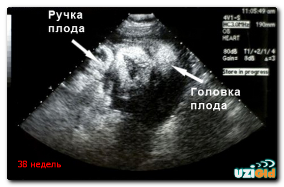 узи на 38 неделе беременности
