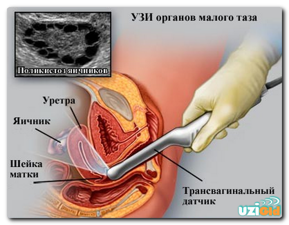 узи малого таза когда лучше делать