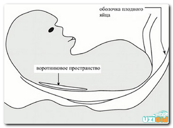 УЗИ ТВП беременности, пороки