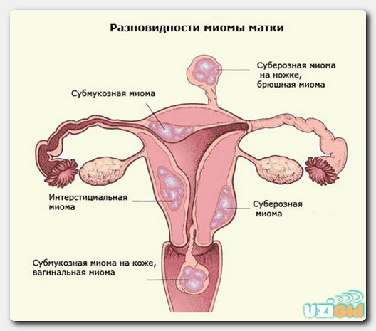 УЗИ при миоме на какой день цикла