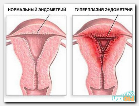 УЗИ при эндометриозе на какой день цикла