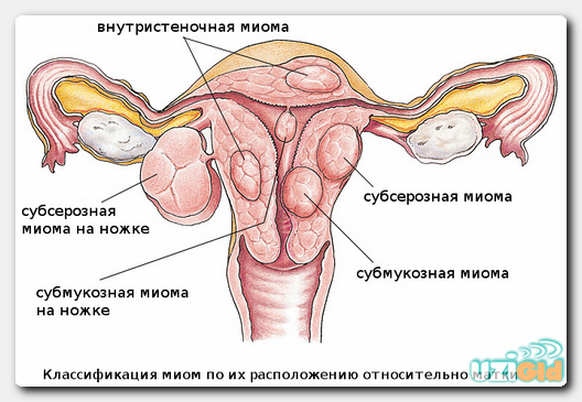 Миома УЗИ малого таза при беременности